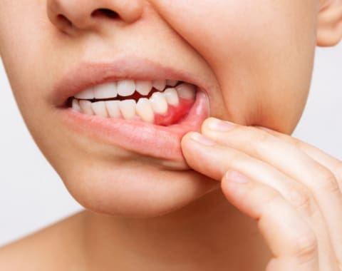 Bleeding Gums