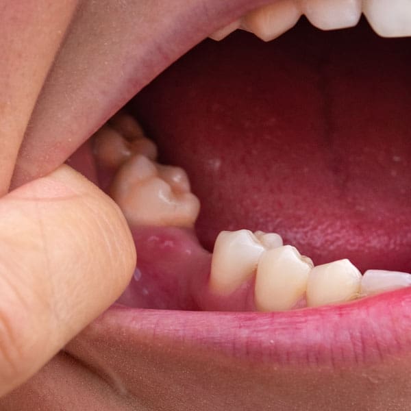 Missing Teeth - Manningtree Dental