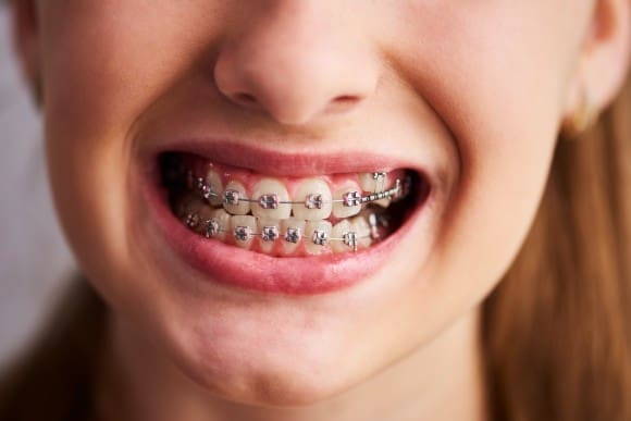 Braces Care Tips