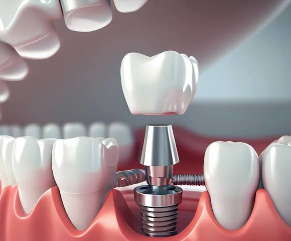 Root Canal Treatment