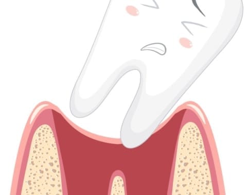 Wisdom Tooth Wobbly